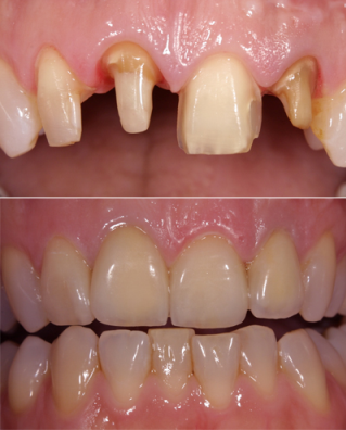 sakura: kroon naast veneer sakura: kroon naast veneer